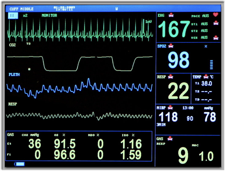 EKG Screen